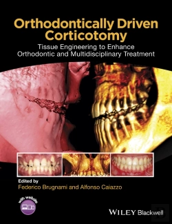 Bertrand.pt - Orthodontically Driven Corticotomy