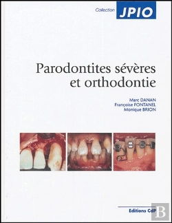 Bertrand.pt - Parodontités Sévères Et Orthodontie
