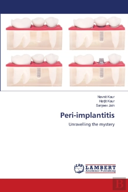 Bertrand.pt - Peri-Implantitis