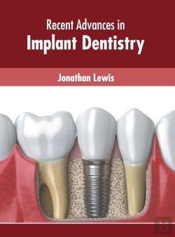 Bertrand.pt - Recent Advances In Implant Dentistry