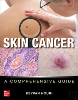 Bertrand.pt - Skin Cancer: A Comprehensive Guide