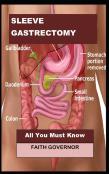 Sleeve Gastrectomy