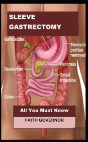 Sleeve Gastrectomy