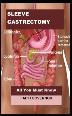 Bertrand.pt - Sleeve Gastrectomy
