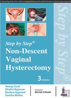 Bertrand.pt - Step By Step: Non-Descent Vaginal Hysterectomy