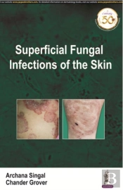 Superficial Fungal Infections Of The Skin