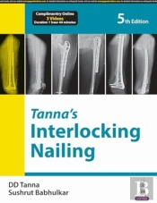 Tannaâ€™S Interlocking Nailing