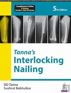 Bertrand.pt - Tannaâ€™S Interlocking Nailing