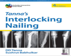 Tanna'S Interlocking Nailing