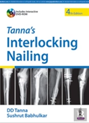 Tanna'S Interlocking Nailing