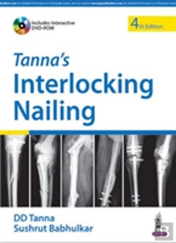 Bertrand.pt - Tanna'S Interlocking Nailing