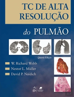 Bertrand.pt - TC de Alta Resolução do Pulmão