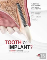 Tooth Or Implant