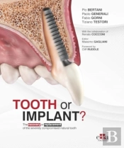 Tooth Or Implant