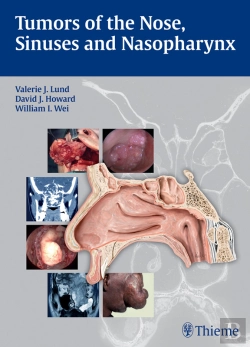 Bertrand.pt - Tumors Of The Nose, Sinuses And Nasopharynx