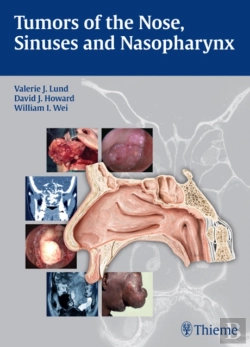 Bertrand.pt - Tumors Of The Nose, Sinuses And Nasopharynx