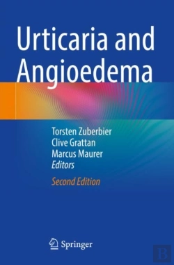 Bertrand.pt - Urticaria And Angioedema