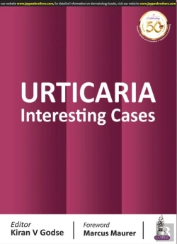 Bertrand.pt - Urticaria