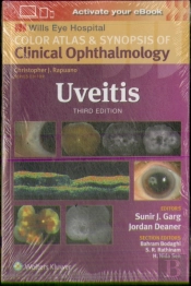 Uveitis