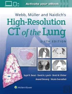Bertrand.pt - Webb, Muller And Naidich'S High-Resolution Ct Of The Lung